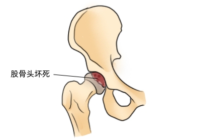 股骨头坏死图片