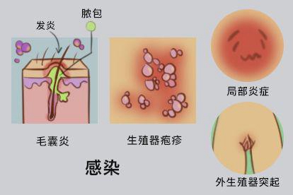 感染的图片